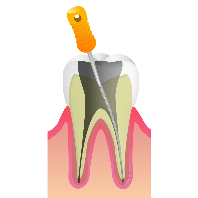 根管治療